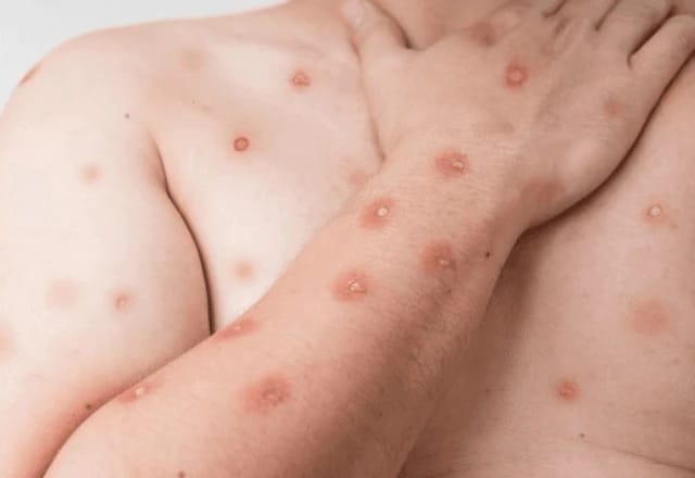 Brasil registra 140 casos confirmados de Mpox e mais de 500 suspeitos em 2026; nenhuma morte foi registrada